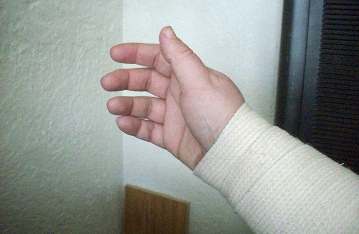 Estudante deve ser indenizado em R$ 14 mil após ter seu braço direito perfurado por lixeira