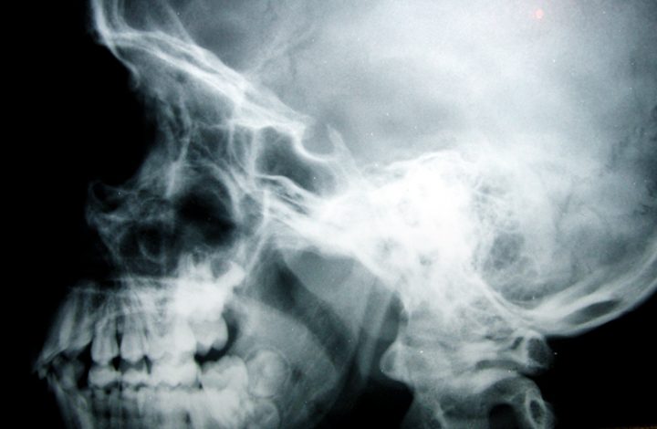 Plano de saúde deve custear procedimento para paciente com traumatismo craniano